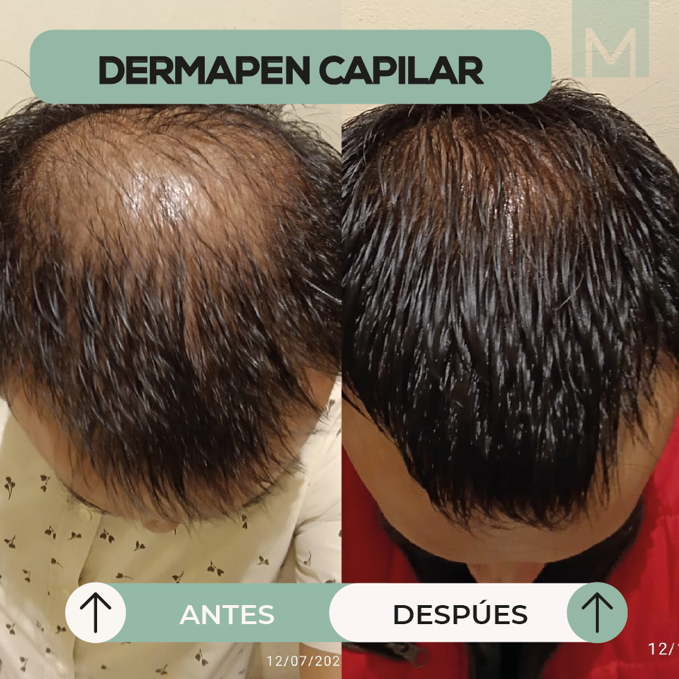 ANTES Y DESPUES INYECTABLES-16