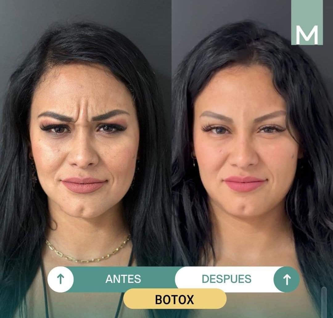 Botox