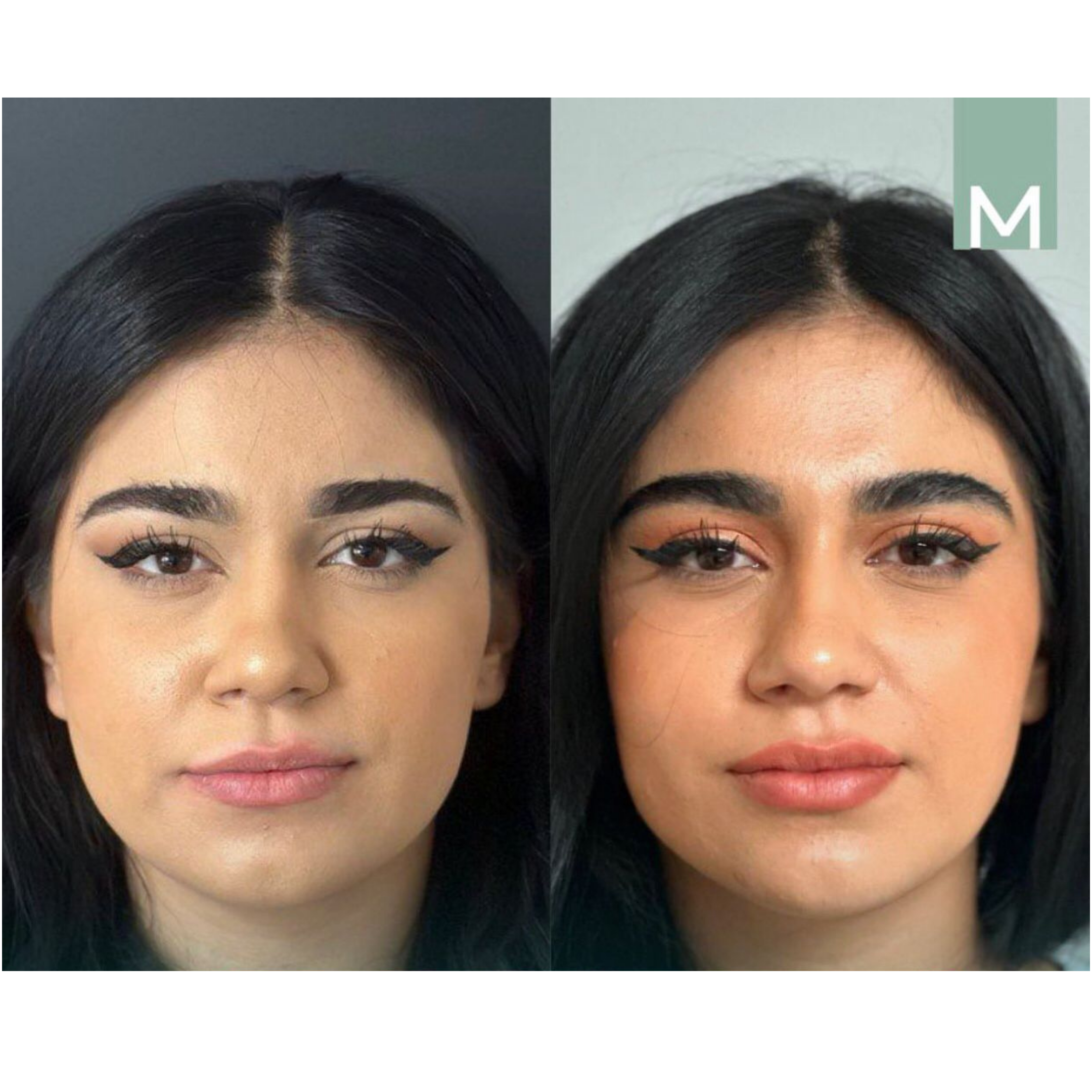 Armonización facial en Medical Skin Clinic